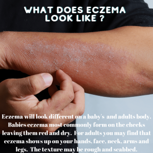 What does eczema look like