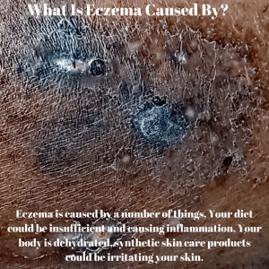 what is eczema caused by?