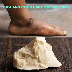Shea and cocoa butter for burns