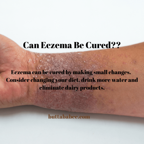 Can eczema be cured?